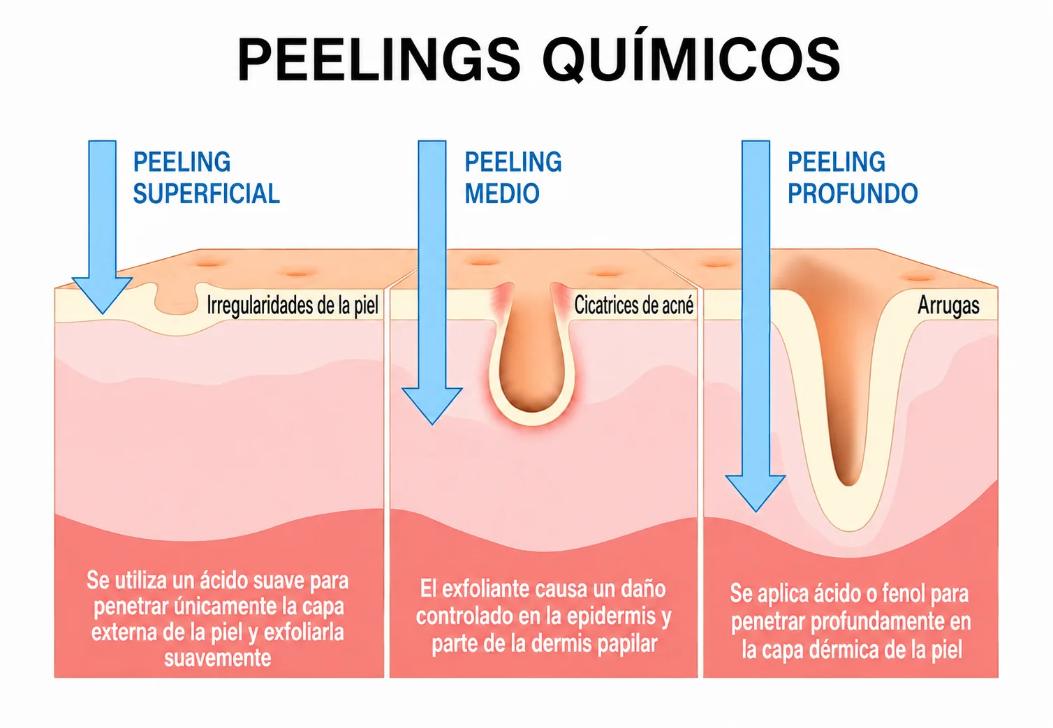 peeling de fenol